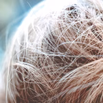 dry scalp and dandruff treatment